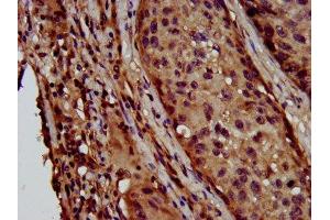 IHC image of ABIN7158792 diluted at 1:600 and staining in paraffin-embedded human lung cancer performed on a Leica BondTM system. (LAPTM4B antibody  (AA 174-226))