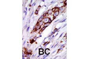 Formalin-fixed and paraffin-embedded human cancer tissue reacted with GRK5 polyclonal antibody  , which was peroxidase-conjugated to the secondary antibody, followed by DAB staining . (GRK5 antibody  (C-Term))