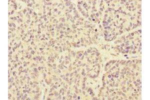 Immunohistochemistry of paraffin-embedded human ovarian cancer using ABIN7167981 at dilution of 1:100 (ARHGEF3 antibody  (AA 287-526))