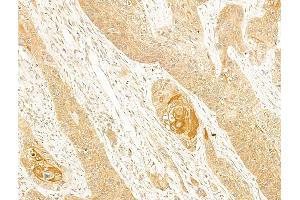 ABIN6256835 and ABIN6273684 at 1/100 staining Human esophageal cancer by IHC-P.