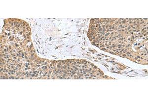 Immunohistochemistry of paraffin-embedded Human esophagus cancer tissue using NFS1 Polyclonal Antibody at dilution of 1:100(x200) (NFS1 antibody)