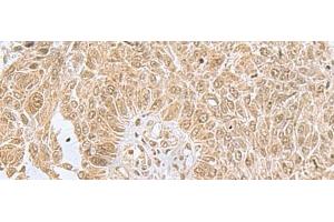 Immunohistochemistry of paraffin-embedded Human lung cancer tissue using PHF6 Polyclonal Antibody at dilution of 1:85(x200)