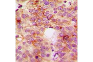 Immunohistochemical analysis of ACOT8 staining in human breast cancer formalin fixed paraffin embedded tissue section. (ACOT8 antibody  (Center))
