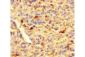 Immunohistochemistry of paraffin-embedded human melanoma using ABIN7176271 at dilution of 1:100 (ZNF384 antibody  (AA 1-245))