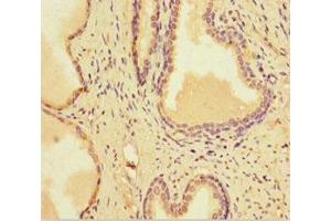 Immunohistochemistry of paraffin-embedded human prostate cancer using ABIN7164517 at dilution of 1:100 (SMARCA1 antibody  (AA 500-601))