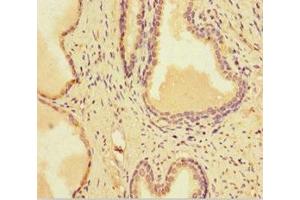 Immunohistochemistry of paraffin-embedded human prostate cancer using ABIN7164517 at dilution of 1:100