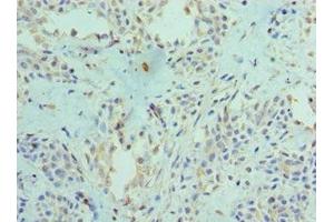 Immunohistochemistry of paraffin-embedded human breast cancer using ABIN7166400 at dilution of 1:100 (PAD4 antibody  (AA 1-250))