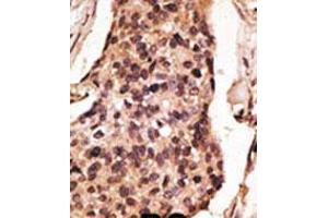 Formalin-fixed and paraffin-embedded human cancer tissue reacted with the primary antibody, which was peroxidase-conjugated to the secondary antibody, followed by DAB staining. (SIGLEC8 antibody  (C-Term))