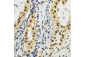 Immunohistochemical analysis of LMO3 staining in human lung cancer formalin fixed paraffin embedded tissue section. (LMO3 antibody  (C-Term))