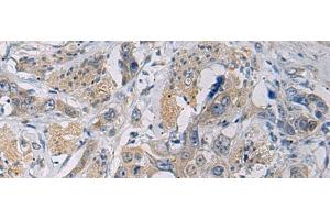 Immunohistochemistry of paraffin-embedded Human esophagus cancer tissue using CYTIP Polyclonal Antibody at dilution of 1:50(x200) (CYTIP antibody)