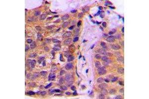 Immunohistochemical analysis of 14-3-3 zeta staining in human breast cancer formalin fixed paraffin embedded tissue section. (14-3-3 zeta antibody  (Center))