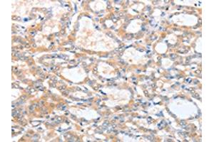 The image on the left is immunohistochemistry of paraffin-embedded Human thyroid cancer tissue using ABIN7128218(ACY3 Antibody) at dilution 1/25, on the right is treated with fusion protein. (Aminoacylase 3 antibody)
