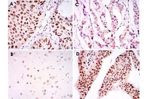 Immunohistochemical analysis of paraffin-embedded human lung cancer tissue (A), brain tissue (B), breast cancer tissue (C) and ovarian cancer tissue (D) using PSIP1 monoclonal antobody, clone 6E4  with DAB staining. (PSIP1 antibody)