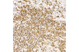 Immunohistochemistry of paraffin-embedded Human nodular Hodgkin lymphoma using CD79a antibody (ABIN7265805) at dilution of 1:100 (40x lens). (CD79a antibody)