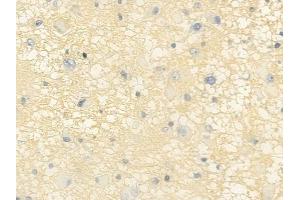 ABIN6257174 and ABIN6275113 at 1/100 staining human astrocytoma by IHC-P. (Epsin 2 antibody  (Internal Region))