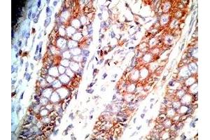 Human colon cancer tissue was stained by Rabbit Anti-GLP-1 (2-24) (Human) Antibody (GLP-1 antibody  (AA 2-24))