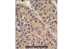 Formalin-fixed and paraffin-embedded human hepatocarcinoma tissue reacted with OC3 antibody (C-term) 7797b , which was peroxidase-conjugated to the secondary antibody, followed by DAB staining. (APOC3 antibody  (C-Term))