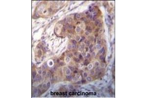 Bit1 Antibody (Center) (ABIN650622 and ABIN2846297) immunohistochemistry analysis in formalin fixed and paraffin embedded human breast carcinoma followed by peroxidase conjugation of the secondary antibody and DAB staining. (PTRH2 antibody  (AA 80-110))