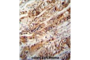 ZC3H15 antibody (C-term) immunohistochemistry analysis in formalin fixed and paraffin embedded human colon carcinoma followed by peroxidase conjugation of the secondary antibody and DAB staining. (ZC3H15 antibody  (C-Term))