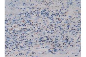 IHC-P analysis of Human Prostate Gland Cancer Tissue, with DAB staining. (IGFBP4 antibody  (AA 22-258))