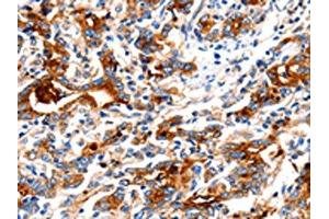 The image on the left is immunohistochemistry of paraffin-embedded Human gastric cancer tissue using ABIN7130018(KLK15 Antibody) at dilution 1/15, on the right is treated with fusion protein. (Kallikrein 15 antibody)