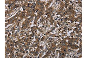 The image on the left is immunohistochemistry of paraffin-embedded Human liver cancer tissue using ABIN7191253(LAIR2 Antibody) at dilution 1/20, on the right is treated with synthetic peptide. (LAIR2 antibody)