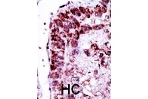 Formalin-fixed and paraffin-embedded human cancer tissue reacted with the primary antibody, which was peroxidase-conjugated to the secondary antibody, followed by DAB staining. (Adenylate Kinase 2 antibody  (N-Term))