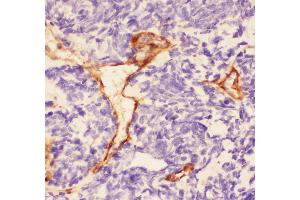 Anti-Laminin Picoband antibody,  IHC(P): Human Lung Cancer Tissue (Laminin antibody)