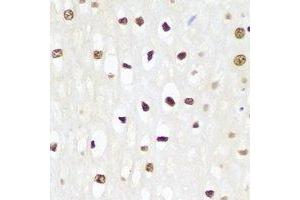 Immunohistochemical analysis of p62 staining in human esophageal cancer formalin fixed paraffin embedded tissue section.