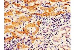 IHC image of ABIN7162288 diluted at 1:400 and staining in paraffin-embedded human liver cancer performed on a Leica BondTM system. (OTC antibody  (AA 33-354))