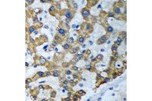 Immunohistochemical analysis of ACT1 staining in human liver cancer formalin fixed paraffin embedded tissue section. (TRAF3IP2 antibody)