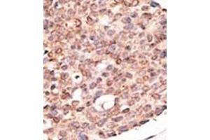 Formalin-fixed and paraffin-embedded human cancer tissue reacted with the primary antibody, which was peroxidase-conjugated to the secondary antibody, followed by DAB staining. (CRY2 antibody  (C-Term))