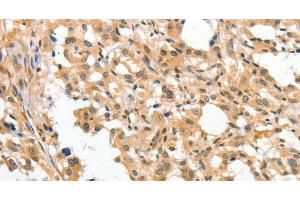 Immunohistochemistry of paraffin-embedded Human thyroid cancer tissue using APTX Polyclonal Antibody at dilution 1:50