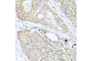 Immunohistochemistry of paraffin-embedded human colon carcinoma using LYZ antibody (ABIN5975352) at dilution of 1/100 (40x lens). (LYZ antibody)