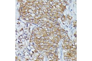 Immunohistochemistry of paraffin-embedded human mammary cancer using Cortactin antibody  at dilution of 1:100 (40x lens). (Cortactin antibody  (AA 1-200))