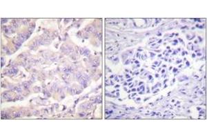 Immunohistochemistry analysis of paraffin-embedded human colon carcinoma tissue, using c-PLA2 (Ab-505) Antibody. (C-PLA2 (AA 471-520) antibody)