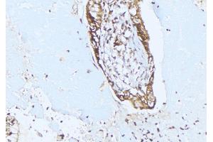 ABIN6275353 at 1/100 staining Human lung cancer tissue by IHC-P. (PEX10 antibody  (Internal Region))