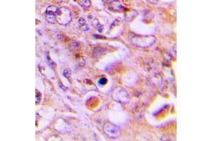 Immunohistochemical analysis of RPL18 staining in human lung cancer formalin fixed paraffin embedded tissue section. (RPL18 antibody  (Center))