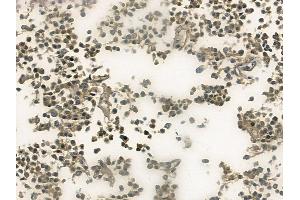 ABIN6256493 and ABIN6267533 at 1/100 staining human glioblastoma by IHC-P.