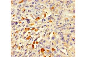 Immunohistochemistry of paraffin-embedded human melanoma using ABIN7143055 at dilution of 1:100 (Actin-Like 7A antibody  (AA 1-435))