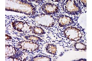 Formalin-fixed and paraffin embedded human colon carcinoma labeled with Anti-GDNFRA Polyclonal Antibody, Unconjugated  at 1:200 followed by conjugation to the secondary antibody and DAB staining. (GFRA1 antibody  (AA 351-429))