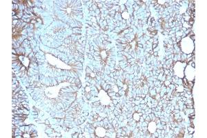 Formalin-fixed, paraffin-embedded human Colon stained with Cadherin 17 / CDH17 Mouse Monoclonal Antibody (CDH17/2617). (LI Cadherin antibody  (AA 242-418))