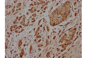 IHC image of ABIN7164633 diluted at 1:100 and staining in paraffin-embedded human pancreatic cancer performed on a Leica BondTM system. (PCOLCE antibody  (AA 169-449))