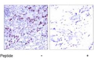 Immunohistochemical analysis of paraffin-embedded human breast carcinoma tissue using GATA1 polyclonal antibody . (GATA1 antibody  (Ser142))