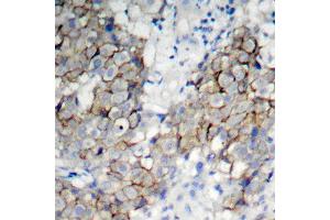 Immunohistochemistry of paraffin-embedded human breast carcinoma using Phospho-IGF1R-Y1161 antibody (ABIN2988064). (IGF1R antibody  (pTyr1161))