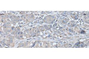 Immunohistochemistry of paraffin-embedded Human breast cancer tissue using RASA1 Polyclonal Antibody at dilution of 1:40(x200) (RASA1 antibody)