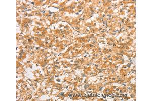 Immunohistochemistry of Human gastric cancer using TLR3 Polyclonal Antibody at dilution of 1:50 (TLR3 antibody)