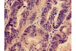 Immunohistochemistry analysis of human colon cancer using ABIN7163177 at dilution of 1:100 (PREX1 antibody  (AA 1-44))