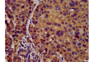 IHC image of ABIN7145029 diluted at 1:500 and staining in paraffin-embedded human pancreatic cancer performed on a Leica BondTM system.