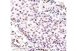 Immunohistochemistry of paraffin embedded human breast cancer using ZKSCAN4 (ABIN7076265) at dilution of 1:400 (400x lens)